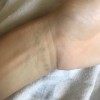 Erased Laser Tattoo Removal