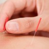 Susana Byers Acupuncture