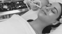 Microdermabrasion