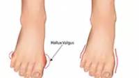 Bunions Treatment